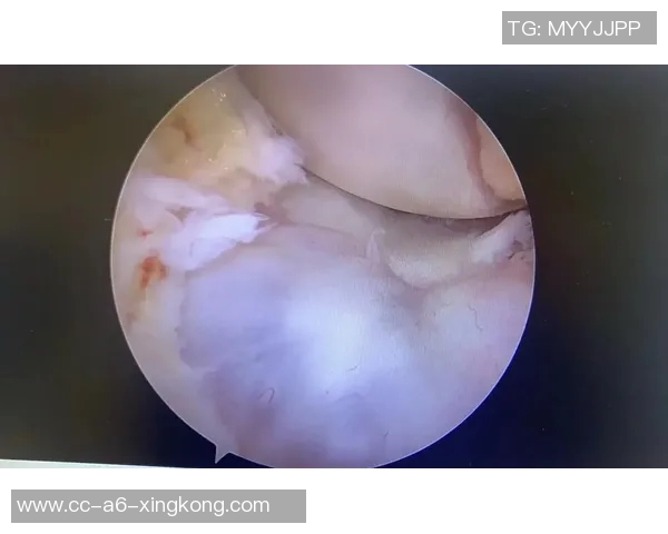 小卡34岁迎生涯首个50分表现ACL部分撕裂与半月板损伤影响膝盖健康